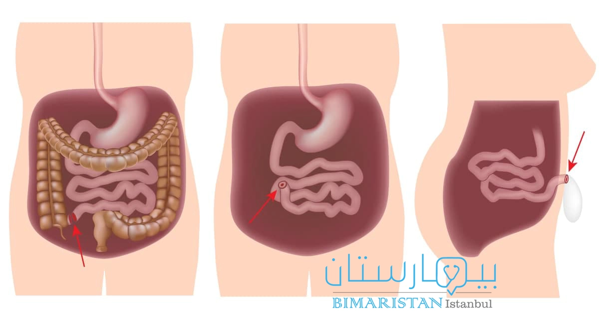 رسم يبين عملية فغر اللفائفي والتي تتم بعد استئصال القولون في إطار علاج التهاب القولون التقرحي