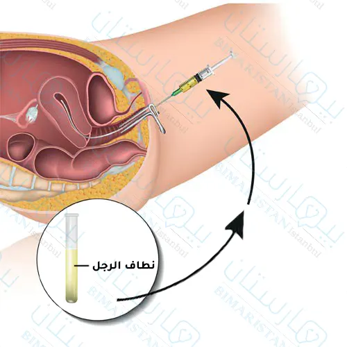 توضح الصورة حقن نطاف الرجل داخل الرحم باستعمال إبرة خاصة، وتعد هذه الطرق من وسائل التلقيح الاصطناعي حيثُ تستعمل عملية التلقيح الاصطناعي لعلاج العقم عند الزوجين