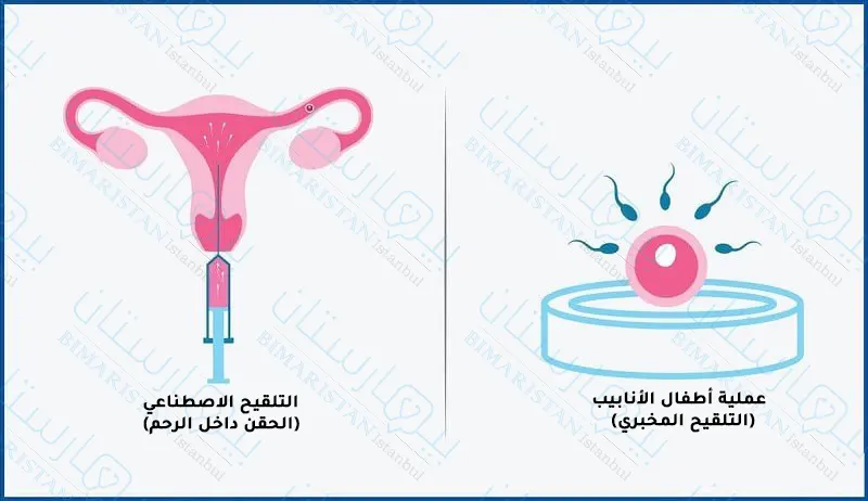 مقارنة بسيطة بين الحقن داخل الرحم وعملية أطفال الأنابيب التي تجرى في تركيا