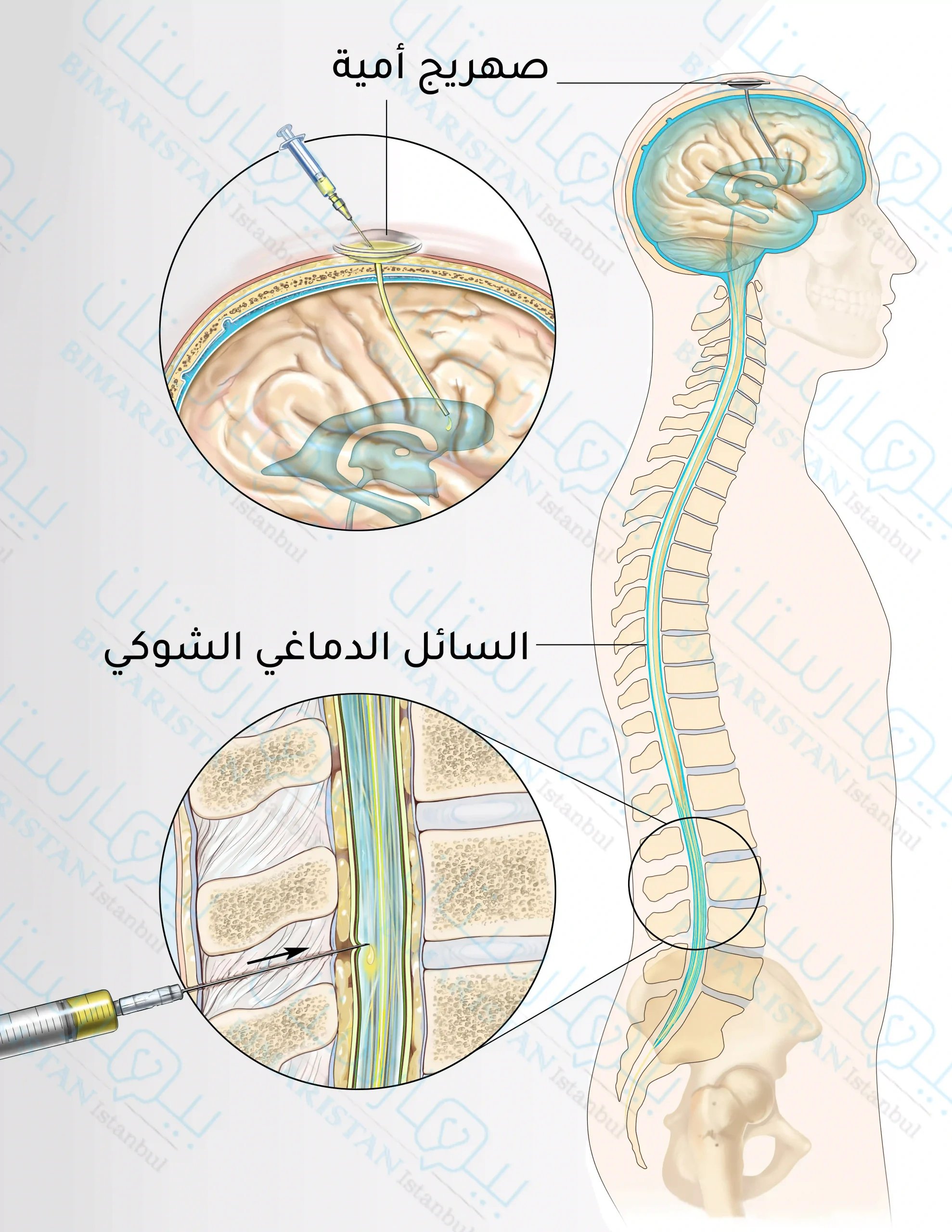 حقن الأدوية الكيميائية داخل القراب أي في القناة الشوكية أو المسافة تحت العنكبوتية (صهريج أمية Ommaya Reservoir هو منطقة نزح السائل الدماغي الشوكي).