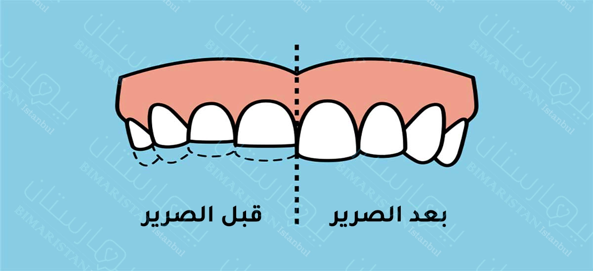 قبل وبعد الصرير والشد على الأسنان