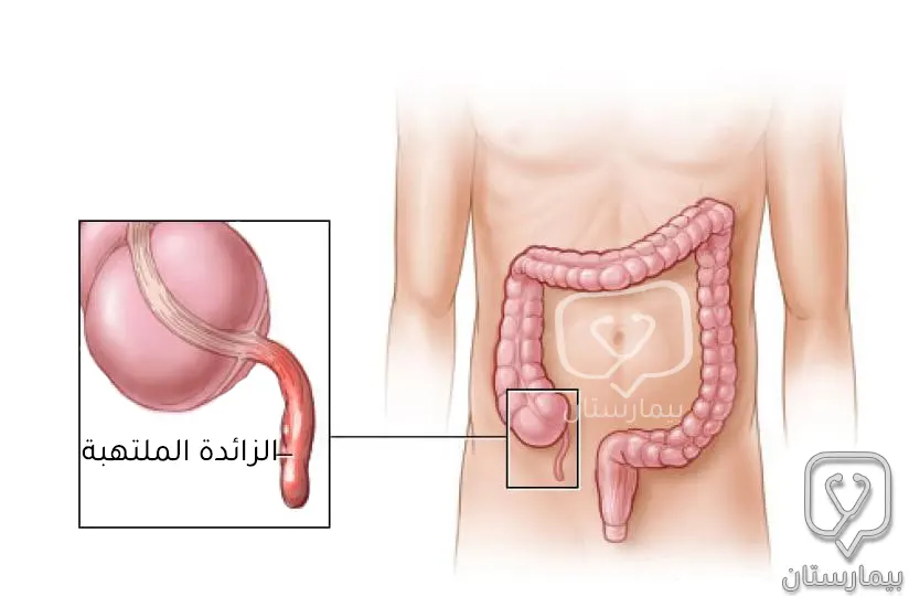 التوضع التشريحي للزائدة الدودية الملتهبة