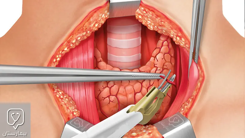 تم فتح العنق جراحياً للوصول إلى الغدة الدرقية