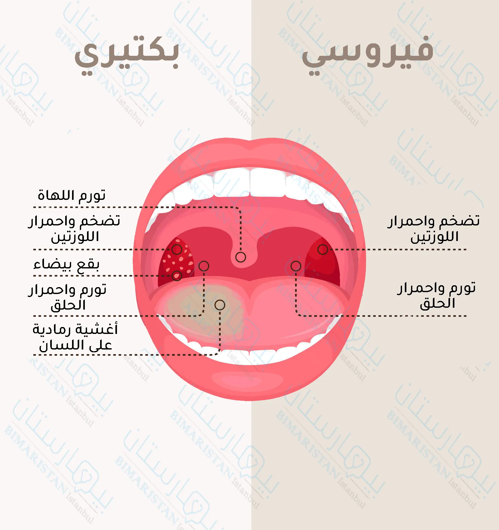 نلاحظ أن التهاب اللوزتين الجرثومي يترافق بأعراض أشد من التهاب اللوزتين الفيروسي كما أنه يمتلك صفات خاصة كالبقع البيضاء على اللوز والأغشية البيضاء على اللسان