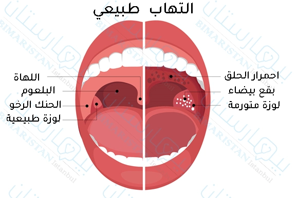 نلاحظ تورم اللوزتين وظهور البقع البيضاء واحمرار الحلق عند إصابة الأطفال بالتهاب اللوزتين