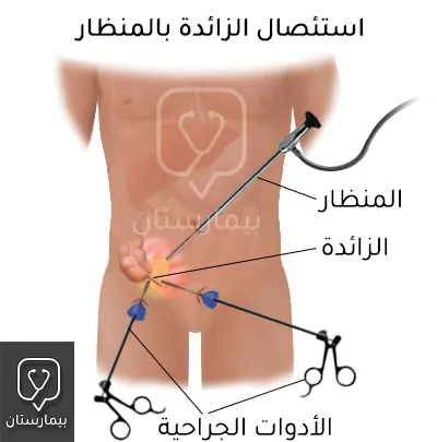 كيفية إجراء عملية الزائدة الدودية بالمنظار