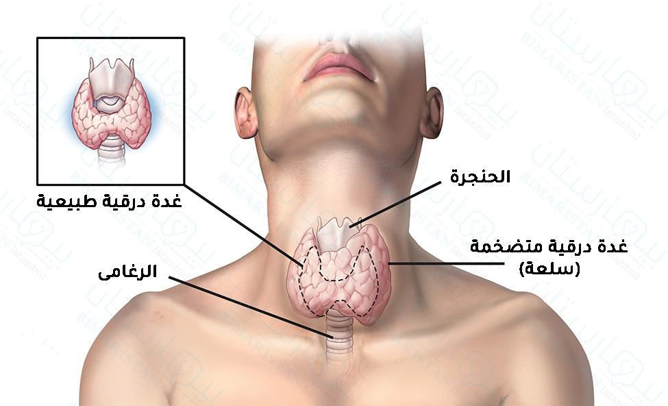 نلاحظ ازدياد حجم الغدة الدرقية عن الطبيعي عندما يحدث فرط نشاط الغدة الدرقية