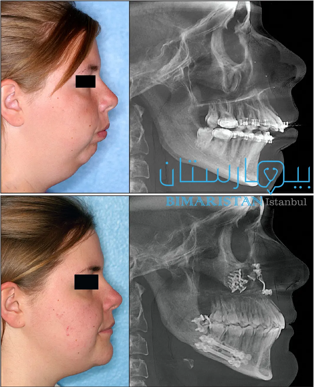 قبل وبعد علاج تراجع الفك السفلي