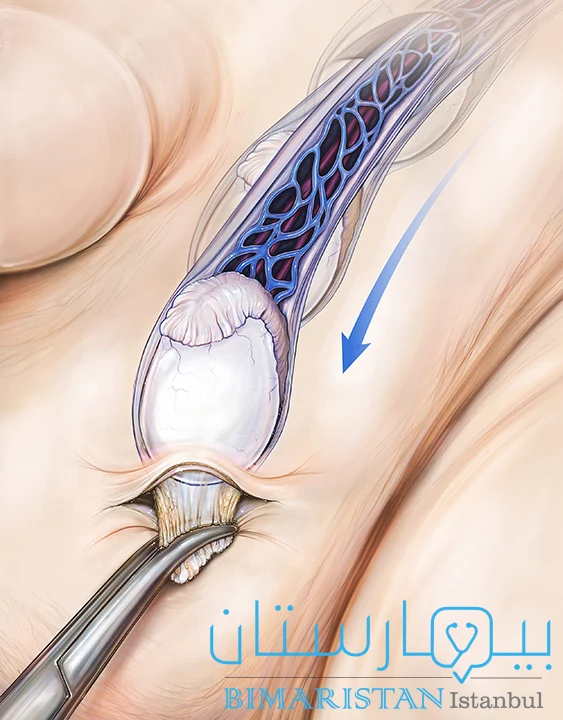 يجري الطبيب شقاً صغيراً في كيس الصفن ويقوم بسحب الْخصية بلطف من خلاله نحو الأسفل