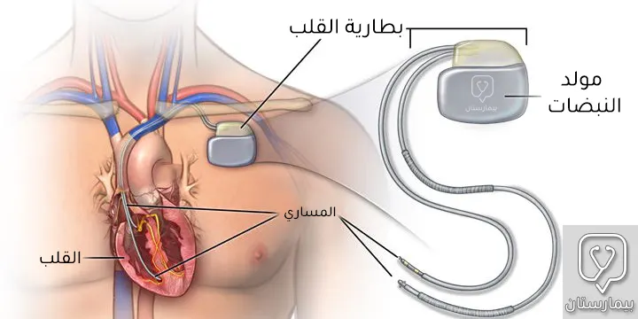 يتألف جهاز تنظيم ضربات القلب من مولد للنبضات ضمن علبة معدنية صغيرة بالإضافة إلى مساري يتم توجيهها عبر الأوردة إلى داخل حجرات القلب