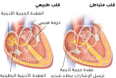 يحدث بطء نبضات القلب عندما ترسل العقدة الجيبية الأذينية الإشارات ببطء شديد