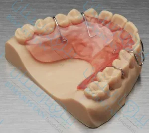 أجهزة التثبيت بعد العلاج التقويمي لعلاج ازدحام الأسنان